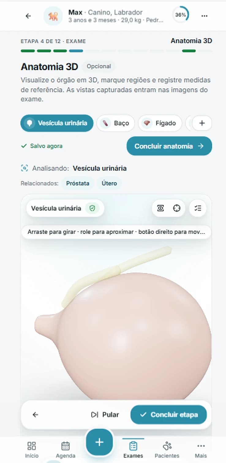 SGUV no celular — etapa Anatomia 3D do exame, com a vesícula urinária em 3D para marcar regiões e medidas